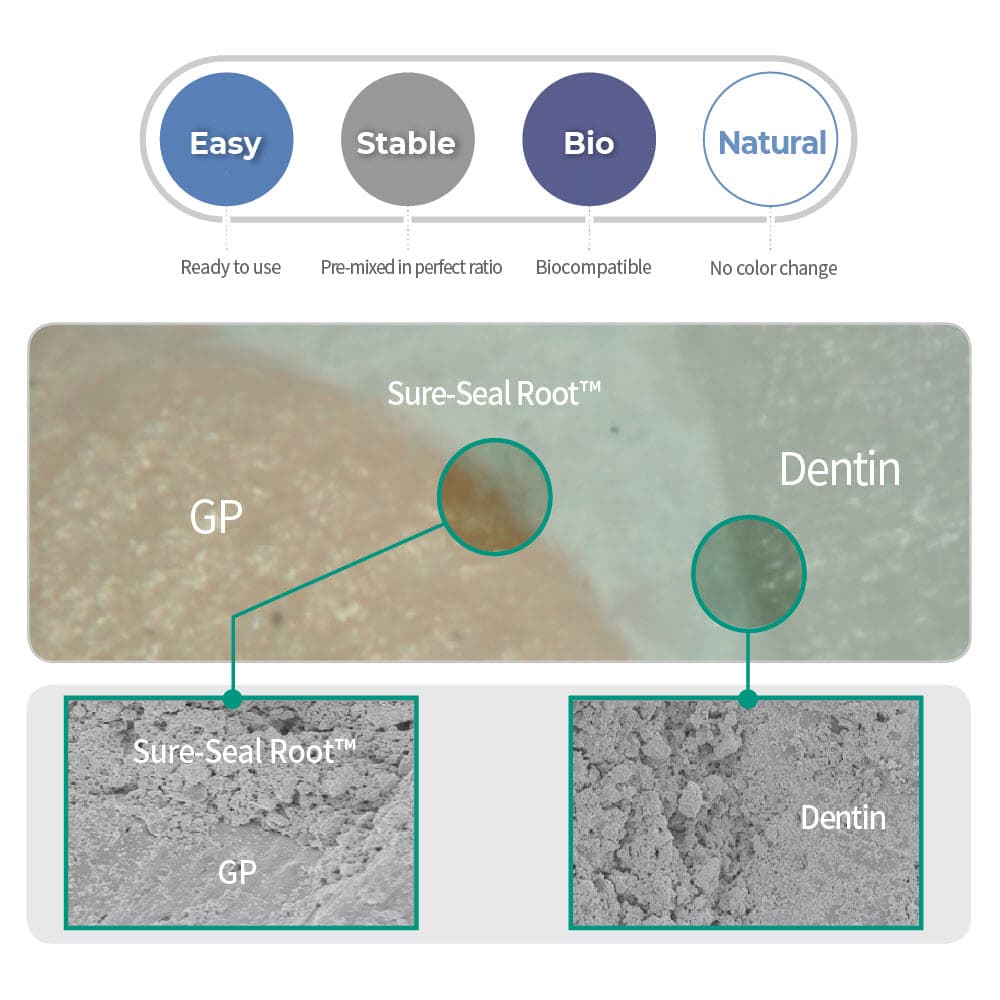 Sure-Seal Root Canal Sealing Material Kit