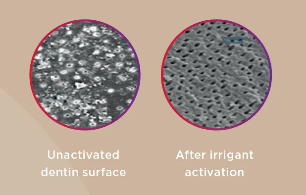 irrigation needle, EndoActivator handpiece, and dentin surface comparison before and after irrigant activation